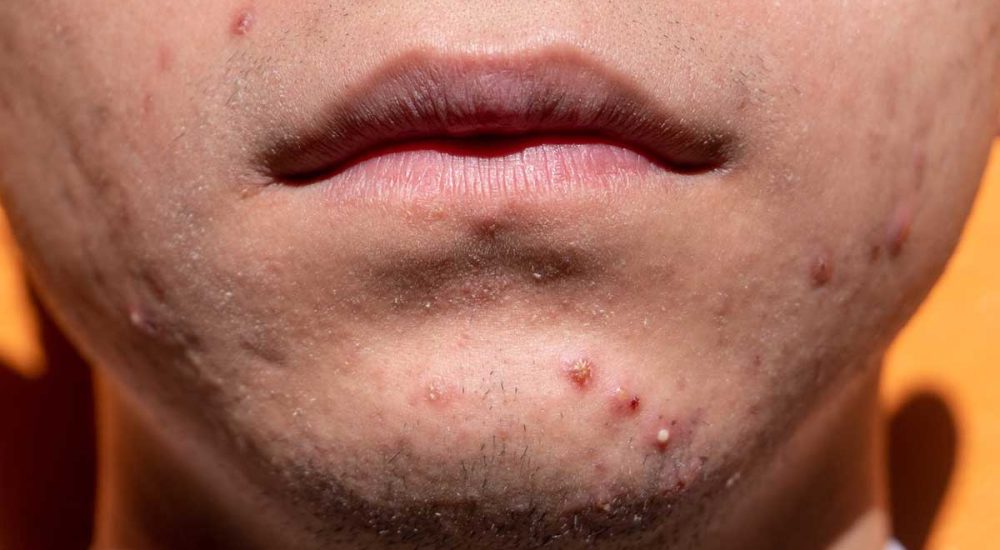 Acne Breakout: Dermatologists Expose the Surprising Truth Behind Your Skincare Routine!